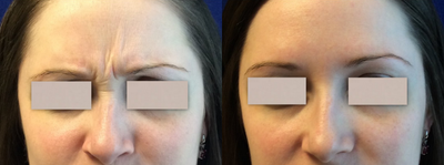 Xeomin before and after photo