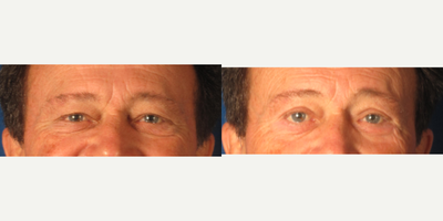 Eyelid Surgery before and after photo