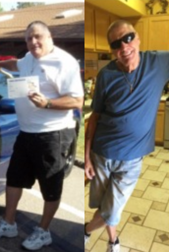 Gastric Bypass before and after photo