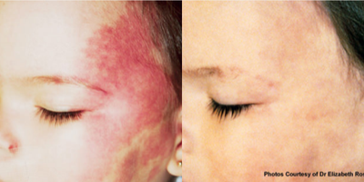 Laser Resurfacing before and after photo