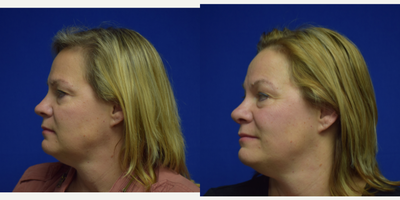 Rhinoplasty before and after photo
