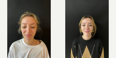 Rhinoplasty before and after photo