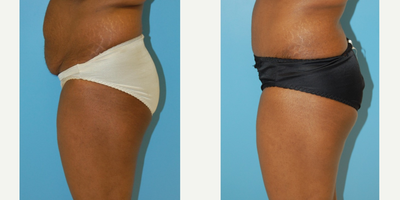 Tummy Tuck before and after photo