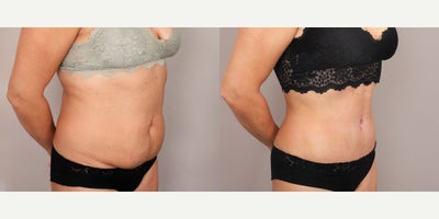 Liposuction before and after photo