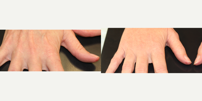 Radiesse before and after photo