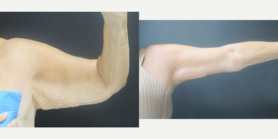 Arm Lift before and after photo