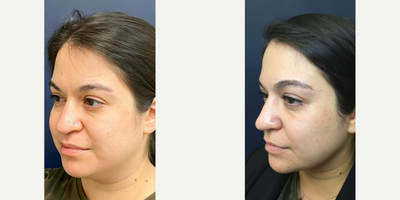 Chin Liposuction before and after photo