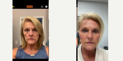 Facelift before and after photo