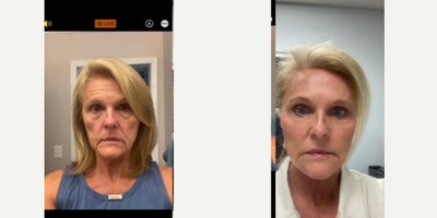 Facelift before and after photo