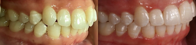 Invisalign before and after photo