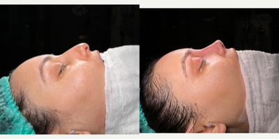Rhinoplasty before and after photo