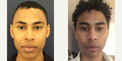 Rhinoplasty before and after photo