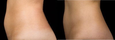 SculpSure before and after photo
