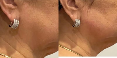 Sculptra before and after photo