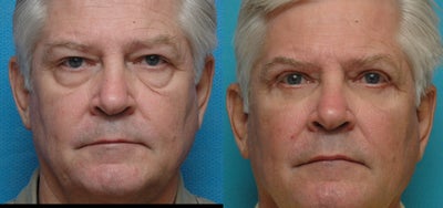 Eyelid Surgery before and after photo