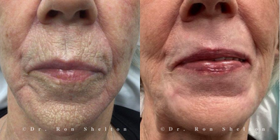 Laser Resurfacing before and after photo