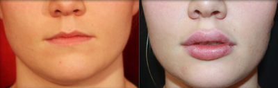 Lip Fillers before and after photo