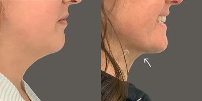 AirSculpt before and after photo
