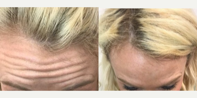 Botox before and after photo