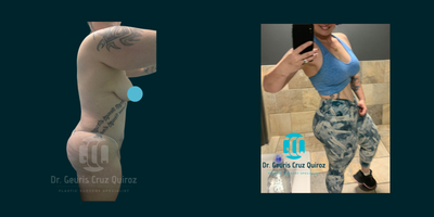 Breast Augmentation before and after photo