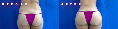 CoolSculpting before and after photo