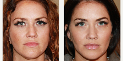 Dermal Fillers before and after photo