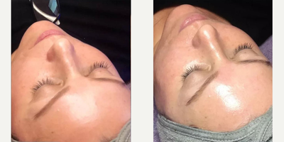 HydraFacial before and after photo