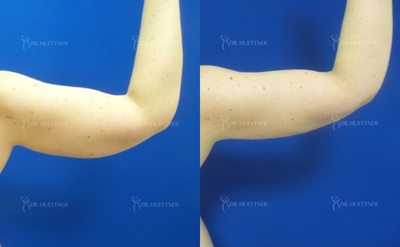 Liposuction before and after photo
