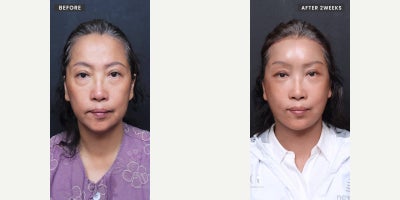 Neck Lift before and after photo