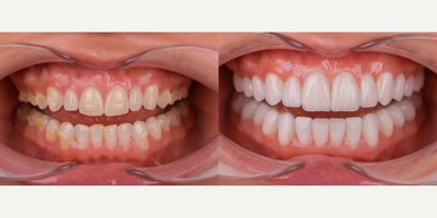 Smile Makeover before and after photo