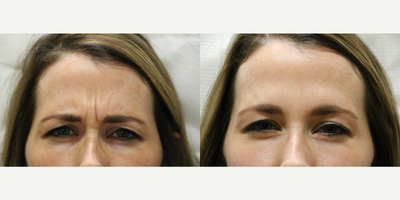 Botox before and after photo