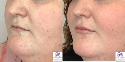 Chin Filler before and after photo