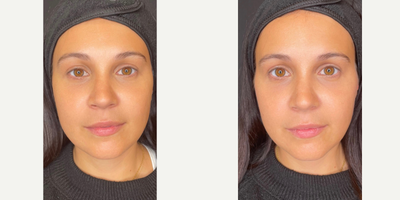 Dermal Fillers before and after photo