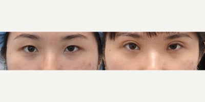 Double Eyelid Surgery before and after photo
