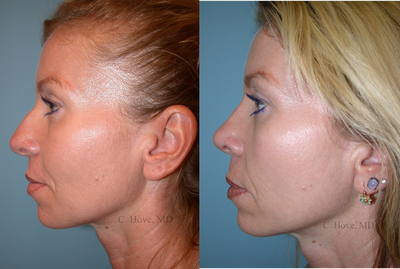 Rhinoplasty before and after photo