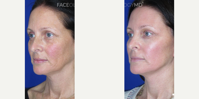 Brow Lift before and after photo