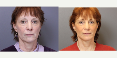 Facelift before and after photo