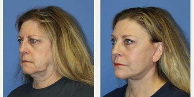 Facelift before and after photo