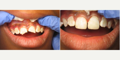 Smile Makeover before and after photo