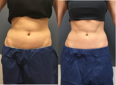 CoolSculpting before and after photo