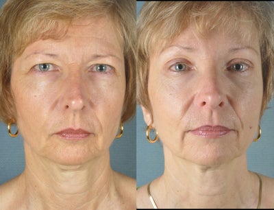Brow Lift before and after photo