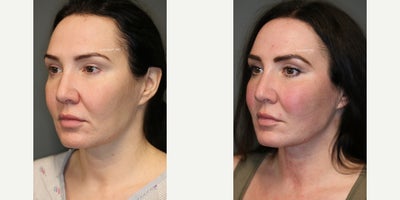 CO2 Laser before and after photo