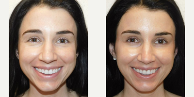 Dysport before and after photo