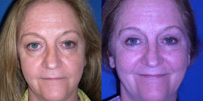 Eyelid Surgery before and after photo