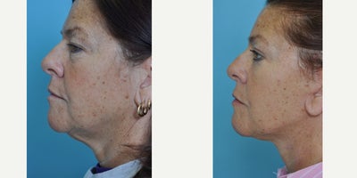Eyelid Surgery before and after photo