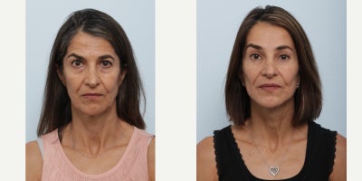 Eyelid Surgery before and after photo