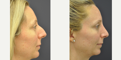 Rhinoplasty before and after photo