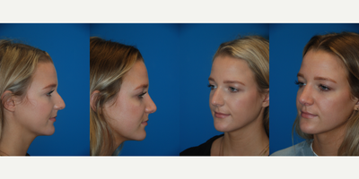 Rhinoplasty before and after photo