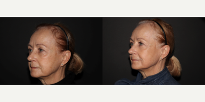 Skin Rejuvenation before and after photo