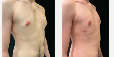 Vaser Liposuction before and after photo